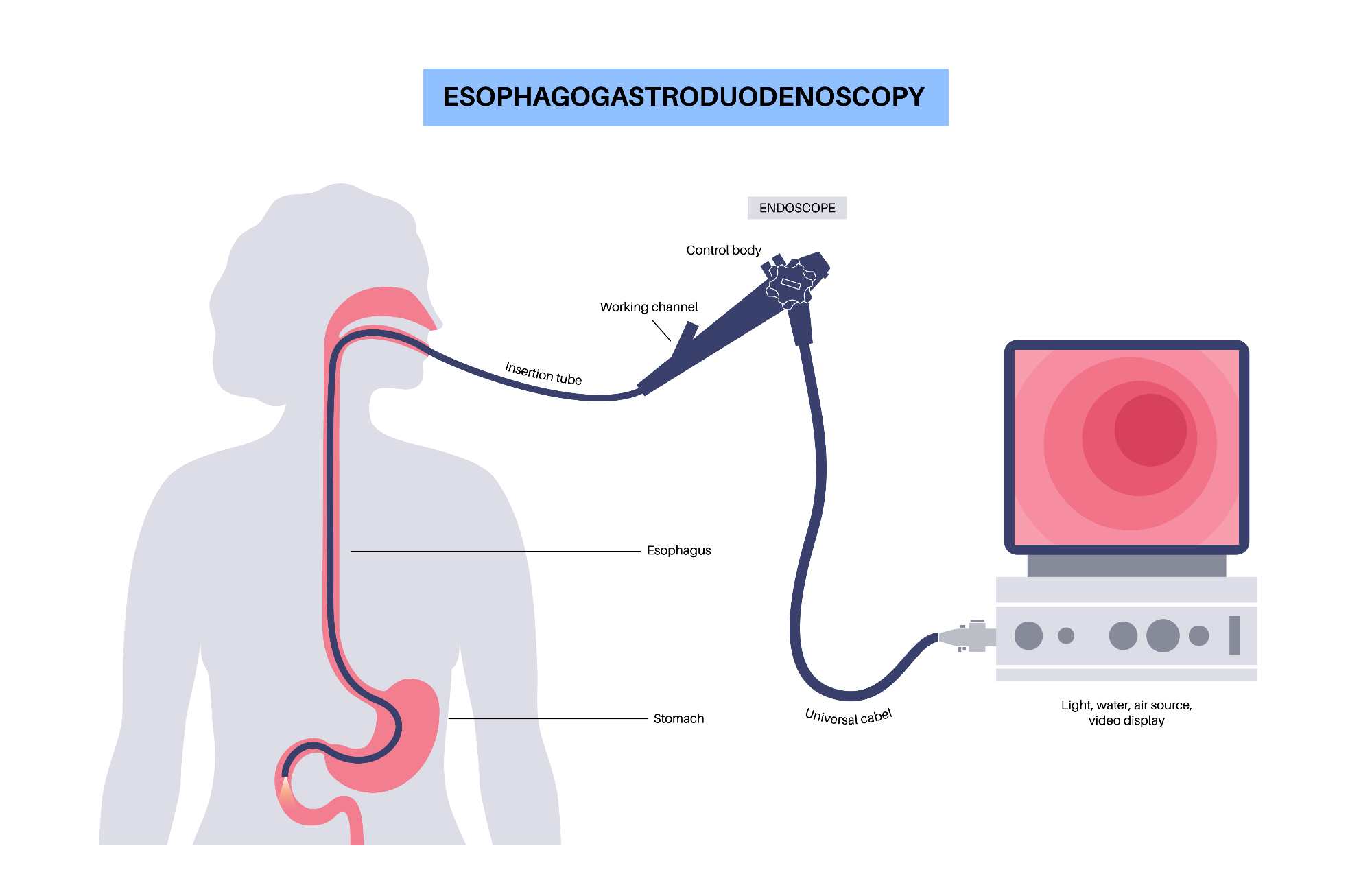 Hitra diagnoza in samoplačniška gastroskopija omogoča tudi hitro ukrepanje